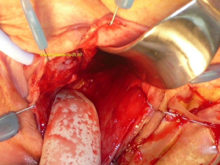 repair surgery vaginal Frothing latex paint